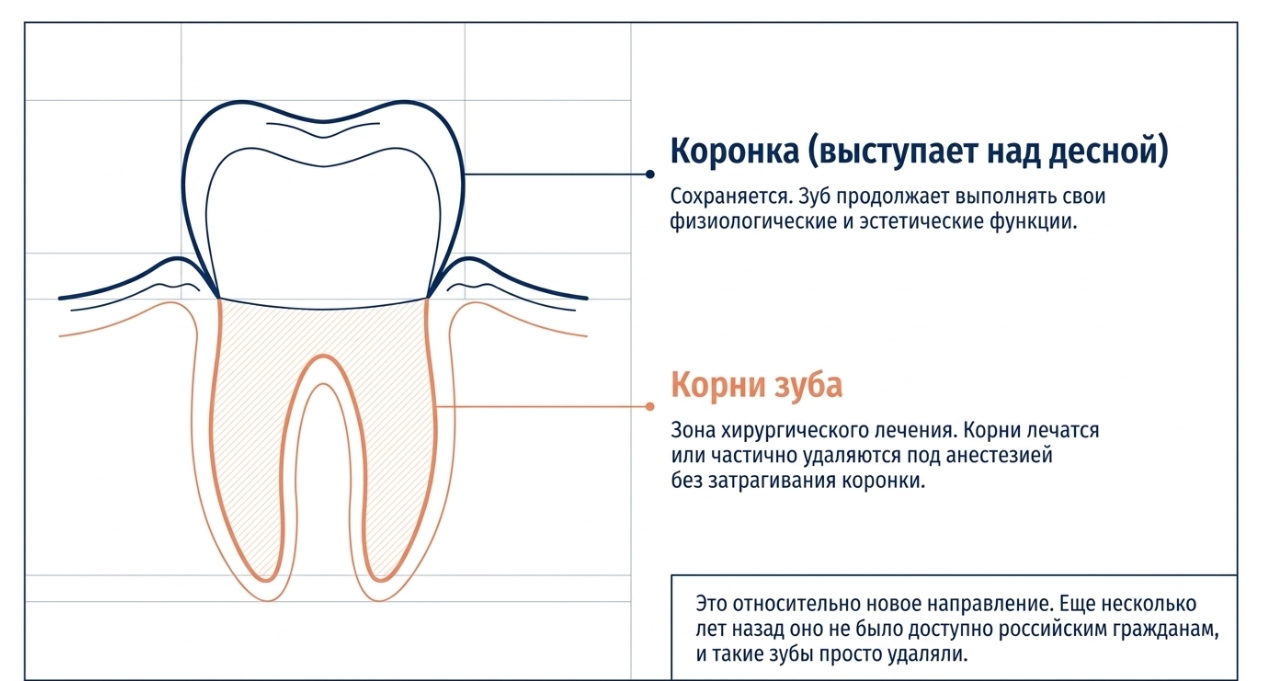 Костная пластика и синус-лифтинг: когда кости не хватает